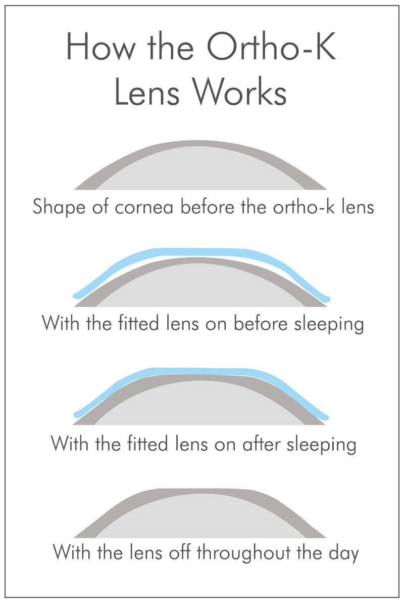 Ortho-K - how it works